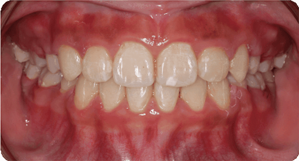 Crowding: after orthodontic treatment