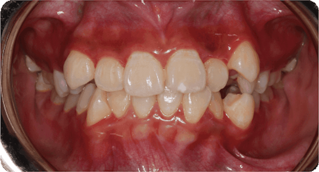 Crowding: before orthodontic treatment