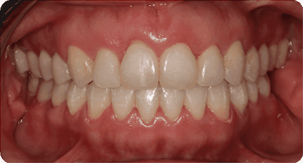 Open bite: after orthodontic treatment